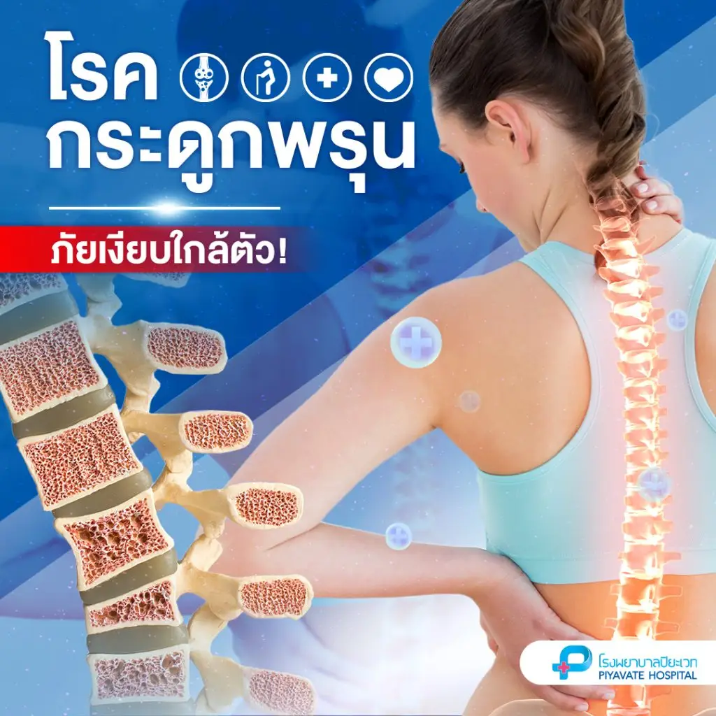โรคกระดูกพรุน คือภาวะที่มวลกระดูกลดลง ทำให้ความแข็งแรงของโครงสร้างกระดูกต่ำ เปราะ และหักง่าย