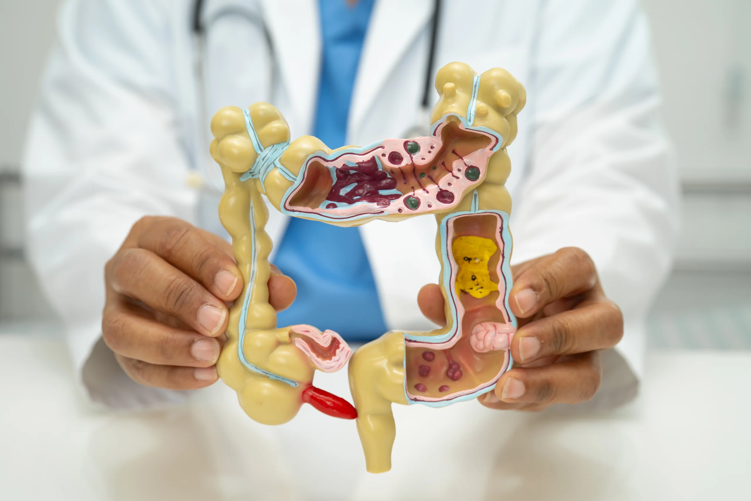 colonoscopy รักษามะเร็งลำไส้ใหญ่ cancer