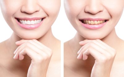 Woman,Teeth,Before,And,After,Whitening.,Asian,Beauty,Model